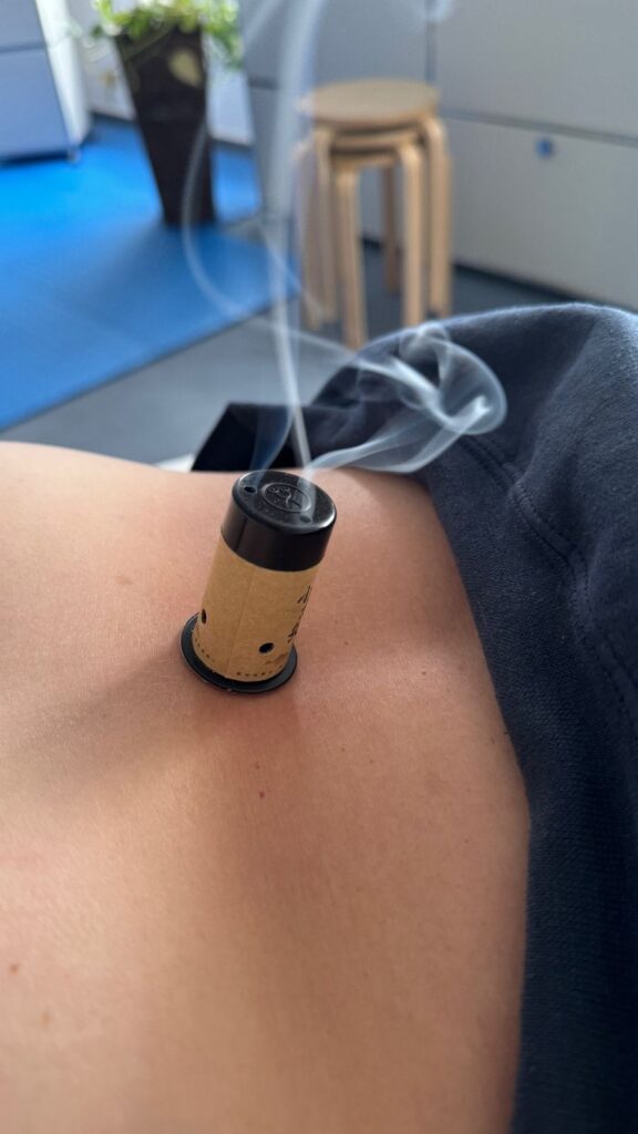 Moxa-Rolle auf der Schulter, Rauch steigt auf